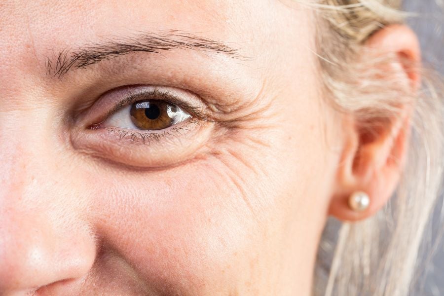 Borse sotto gli occhi: le cause più comuni (e cosa può aiutare davvero)